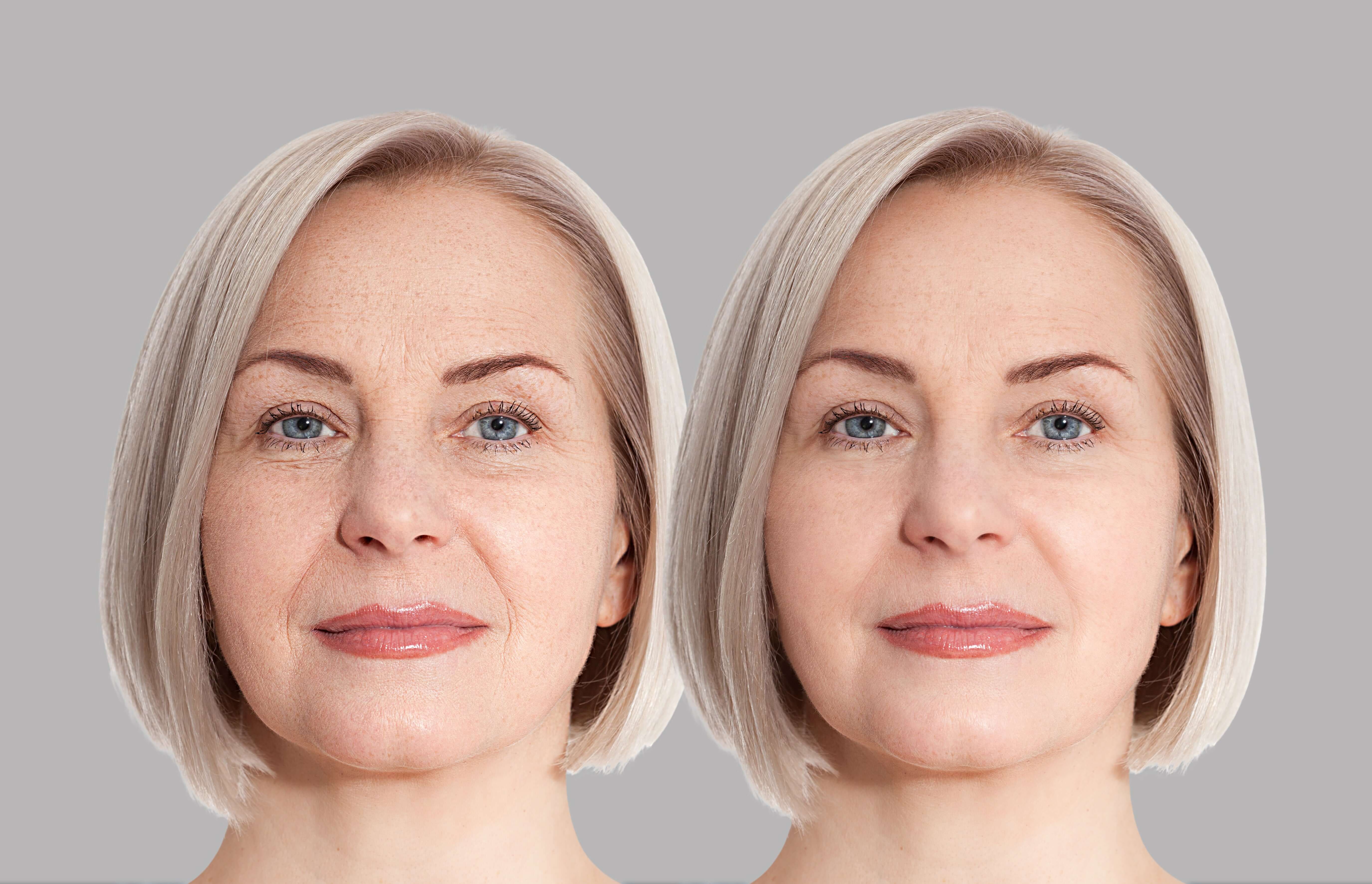 Before and after image of a middle-aged woman showcasing a youthful skin transformation.
